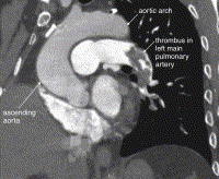 Ct Pneuangio